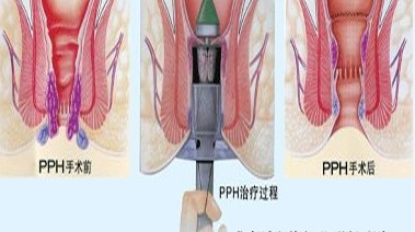 大同痔疮微创手术多少钱
