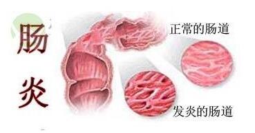 如何预防直肠炎反复发作