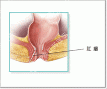 治疗肛瘘的手术费用是多少