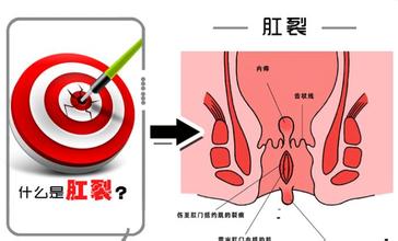 肛裂大便出血怎么治疗