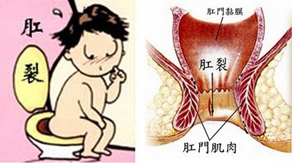 肛裂的治疗原则有哪些