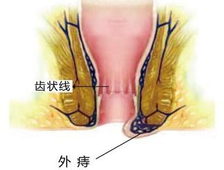 治疗外痔哪种方法比较好