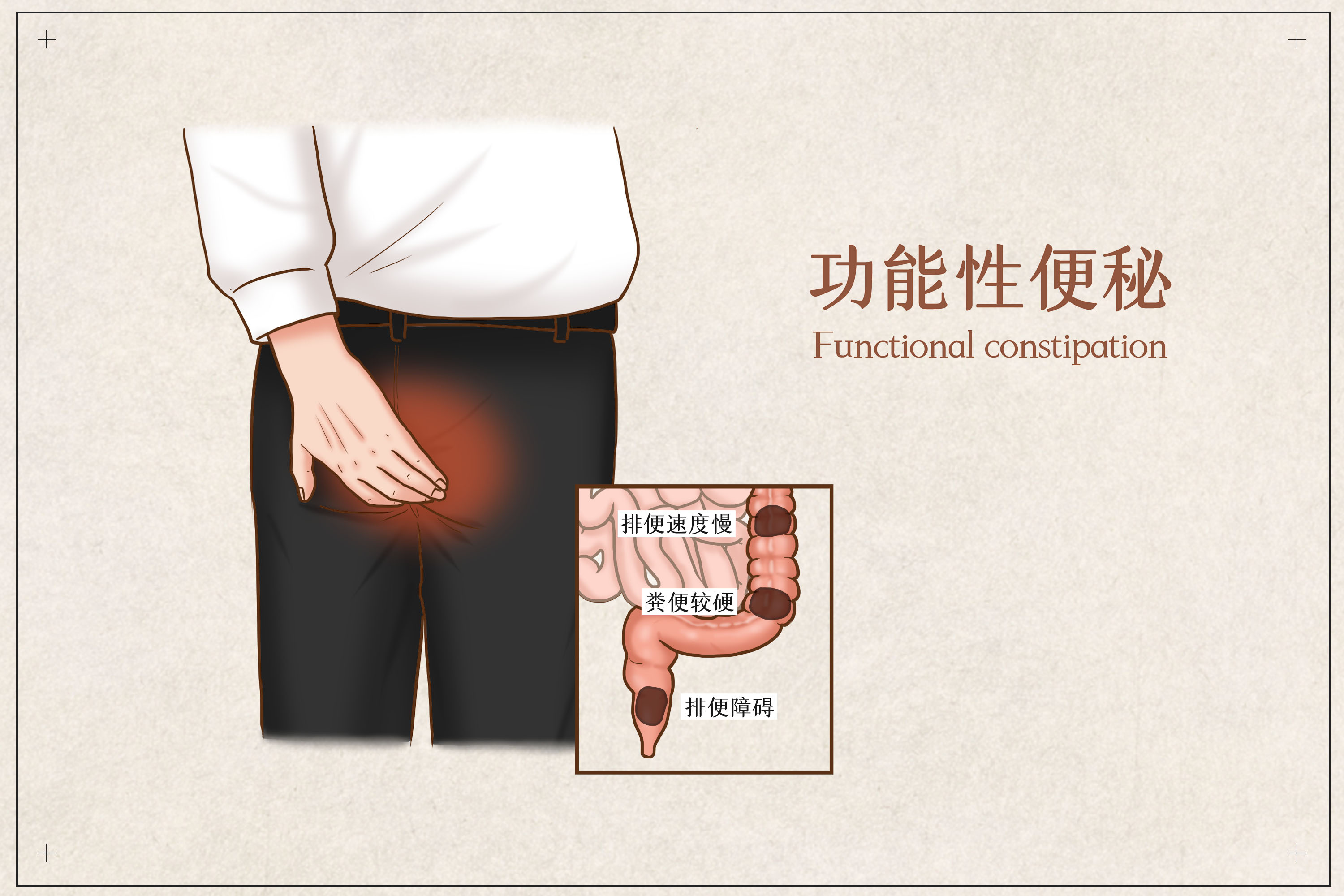 便秘堵在肛门口怎么办