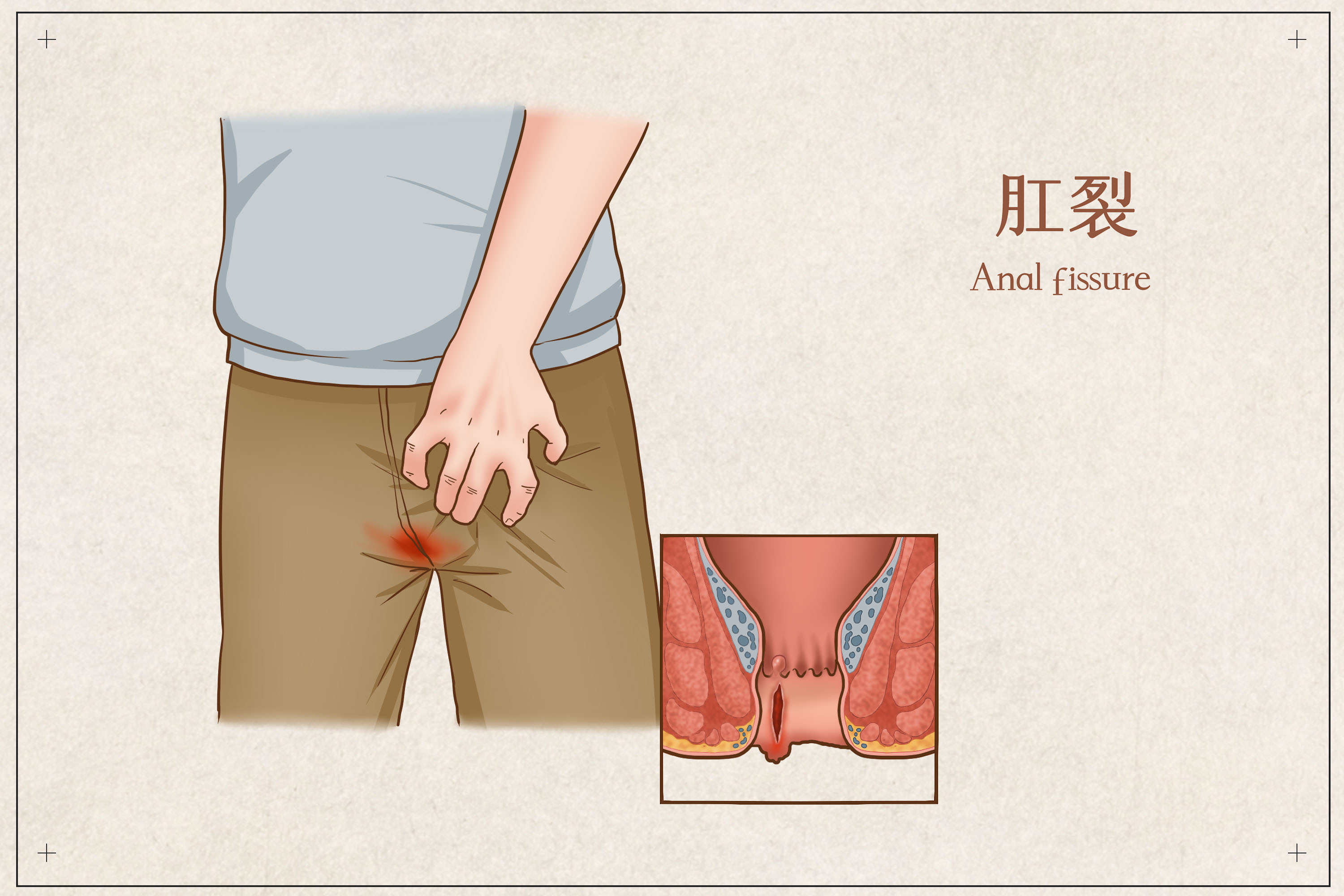 大便后擦屁股纸上有血是咋回事