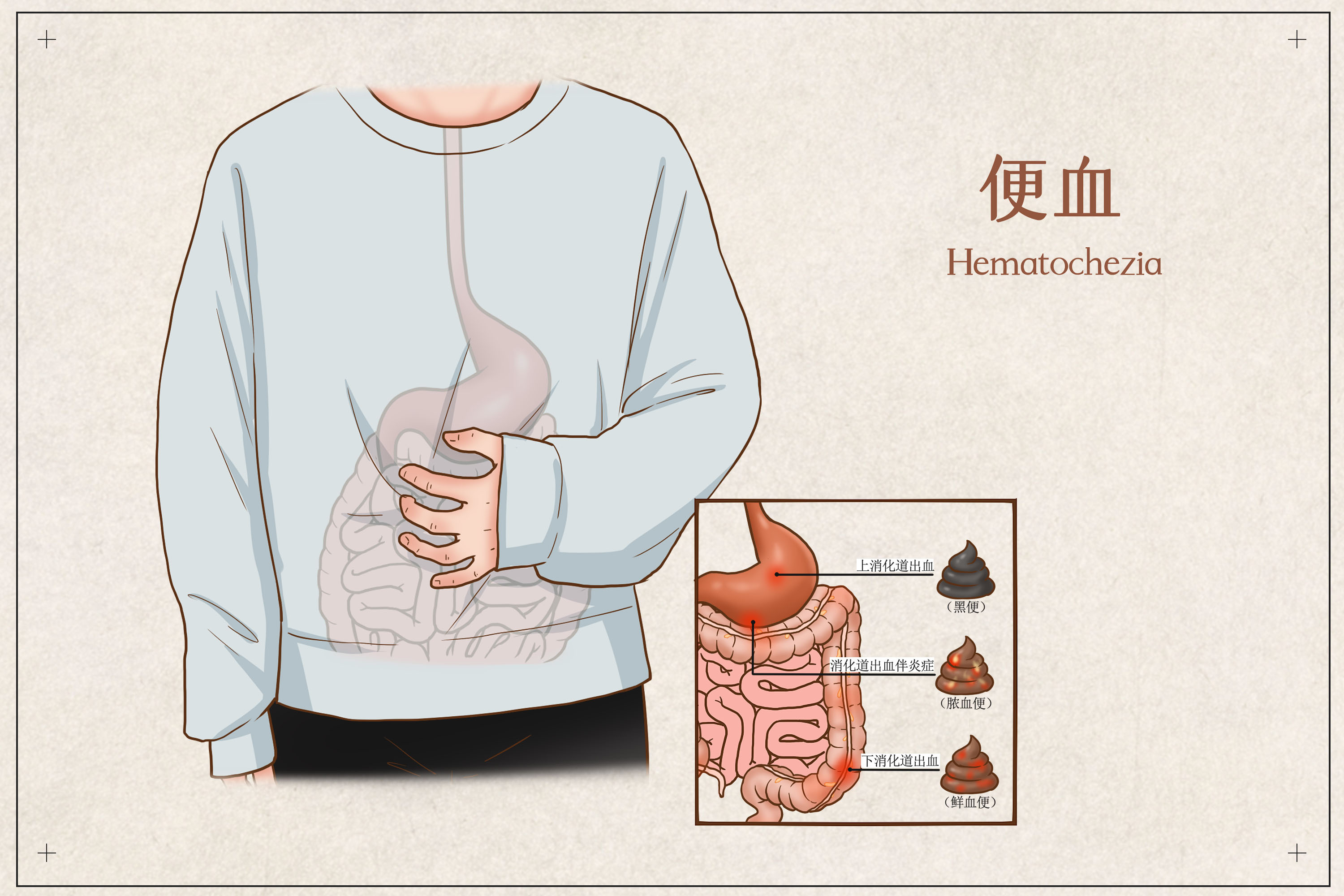 肛门出血
