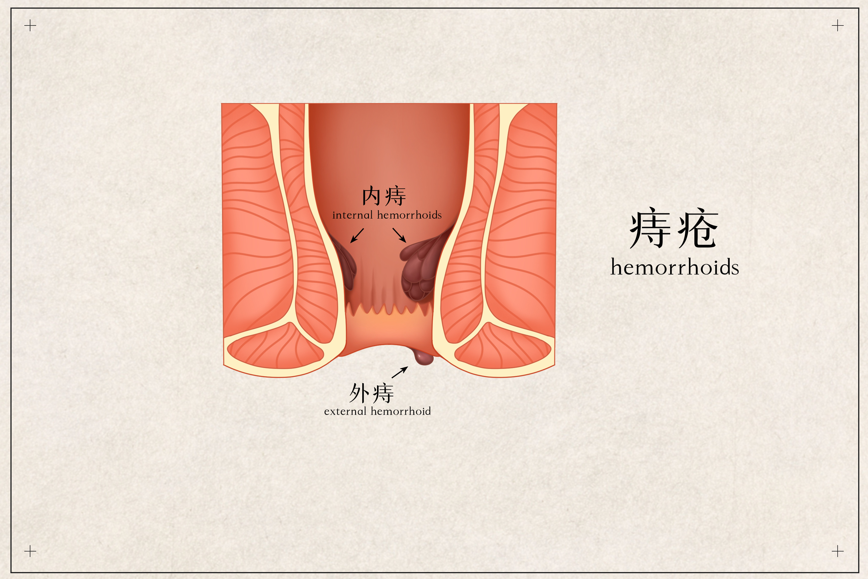 痔疮照片早期男性图片